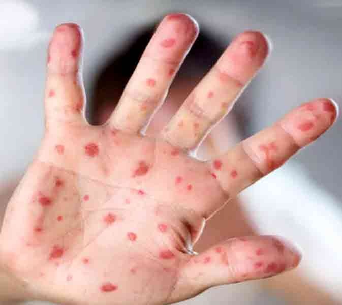 monkeypox death india asia kerala outbreak mpx