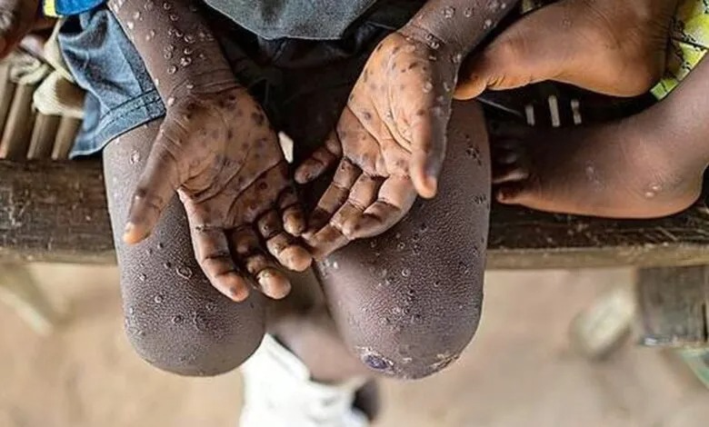 monkeypox death africa ghana outbreak